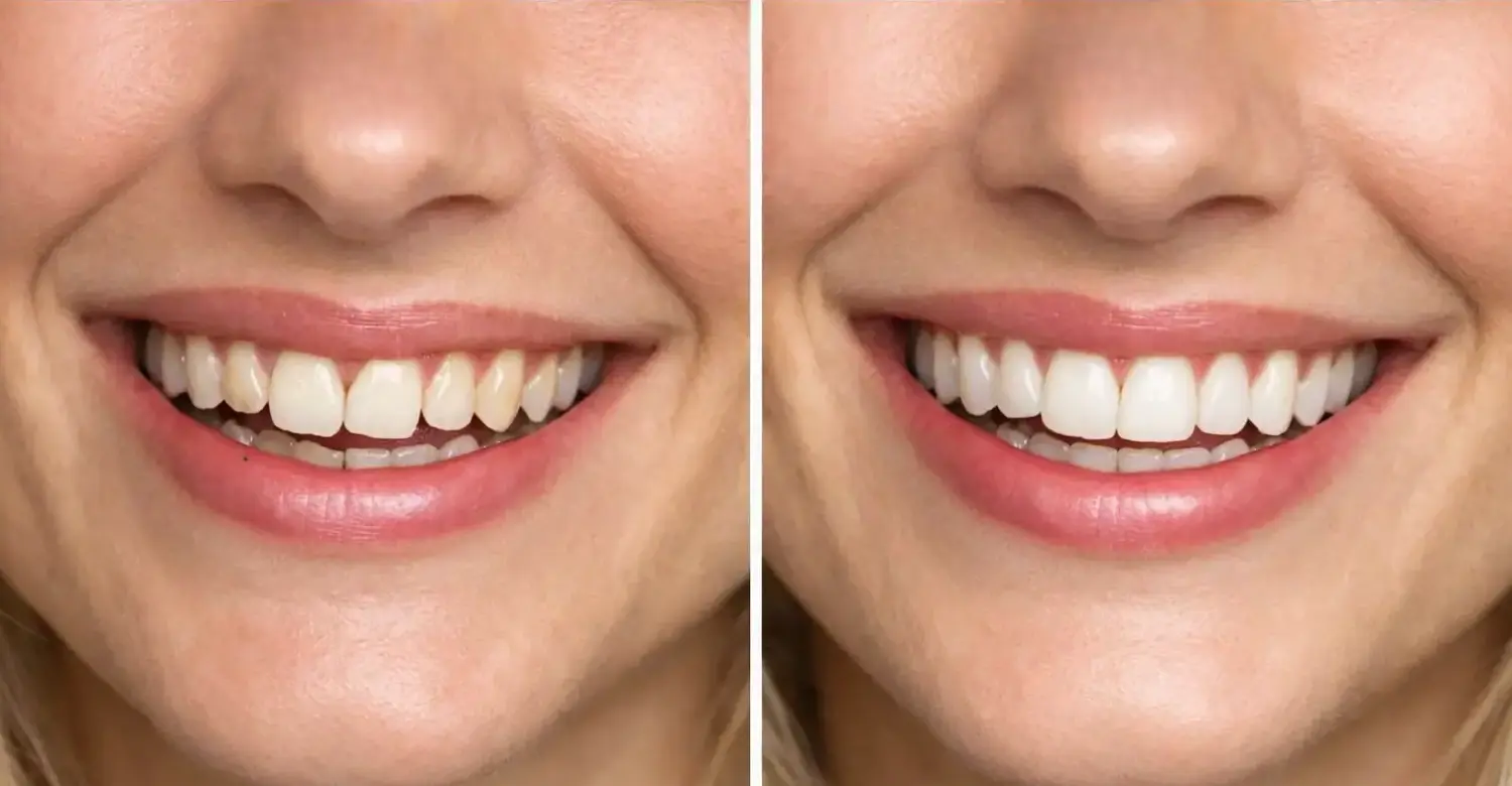 Cosmetic Bonding 2